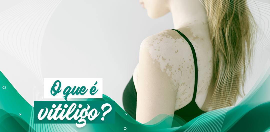 O que é vitiligo - IMC Brasil